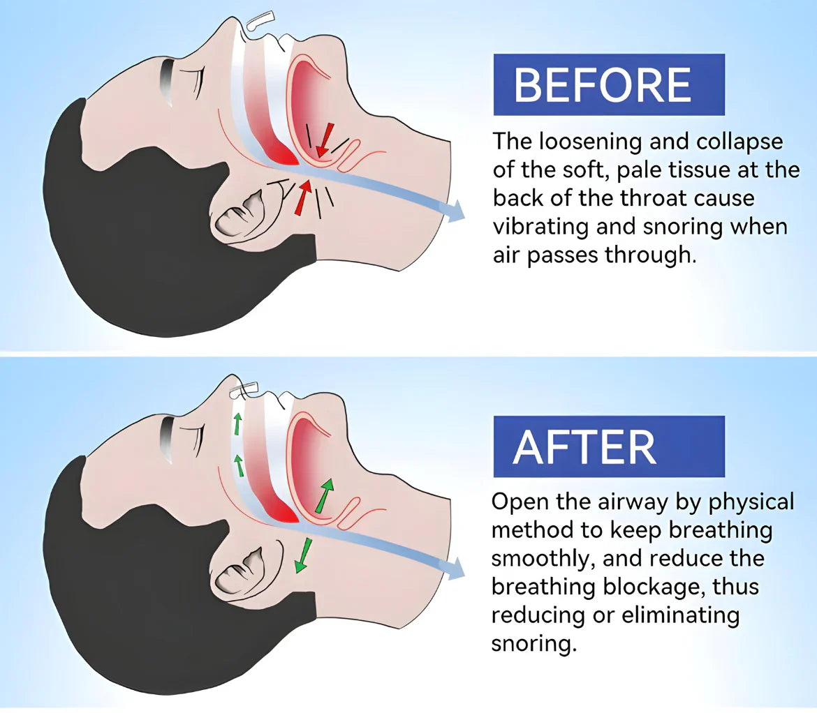 Airflow Clip Nasal Dilator